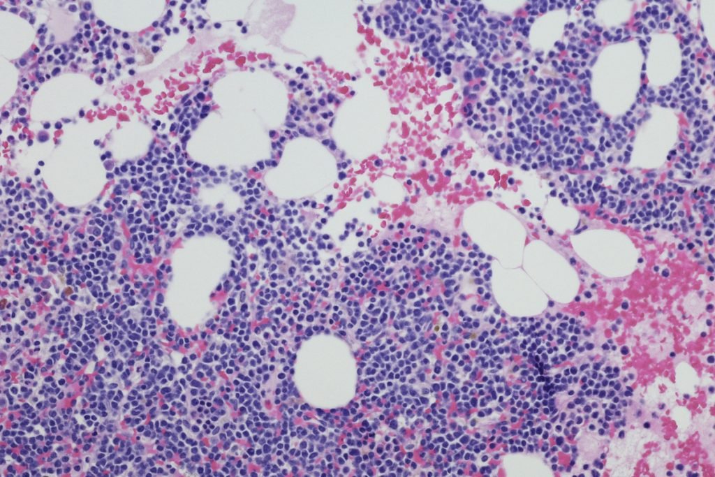 Multiple Myeloma Nedir?