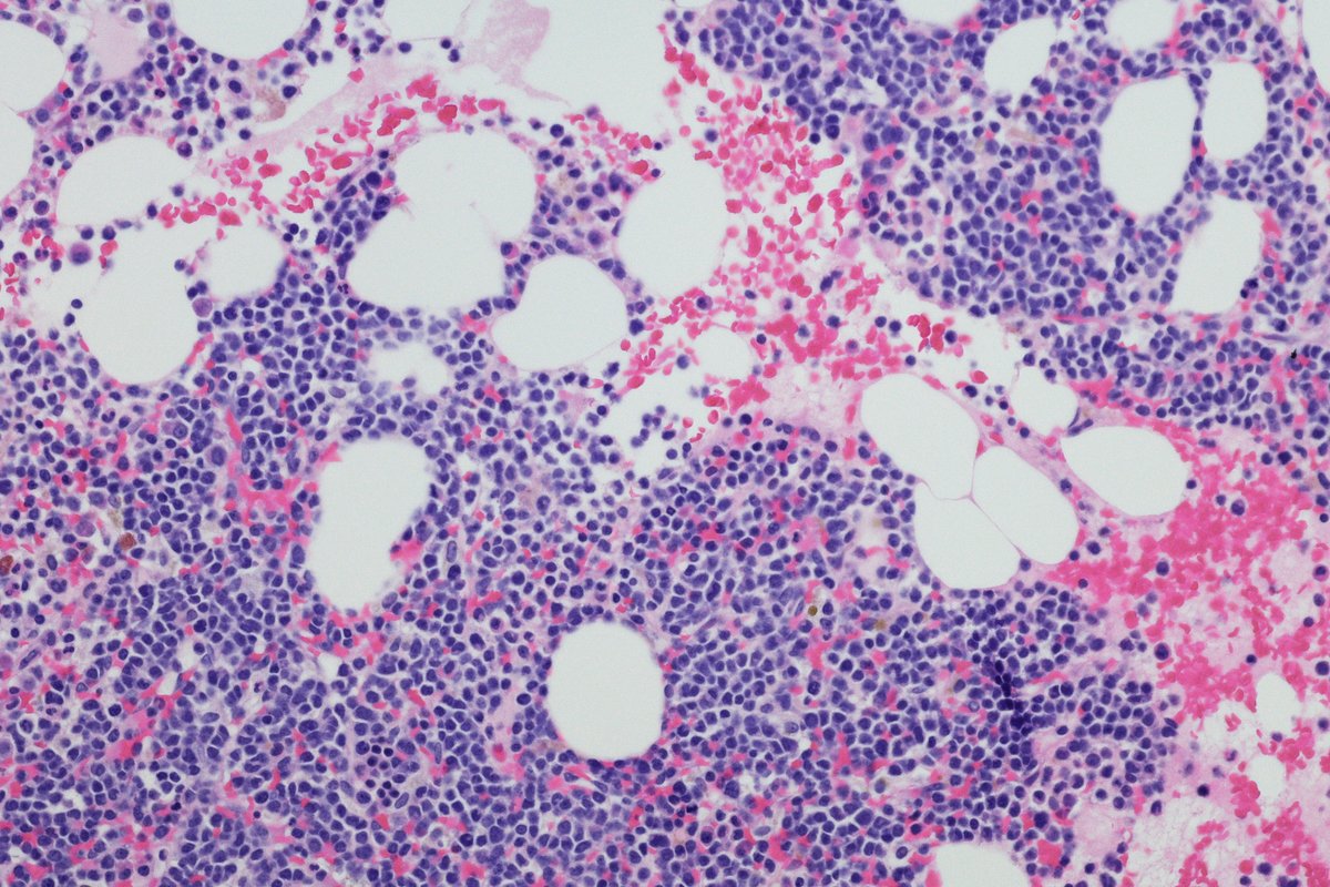 Multiple Myeloma Tedavisinde Yeni Onay: Belantamab